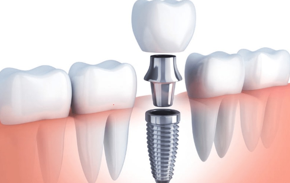 how dental implants happens